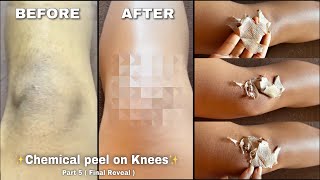 TCA Chemical Peel On Knees Part 5  Sristy Dutta [upl. by Egwin986]