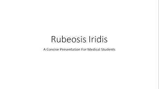 Rubeosis Iridis  Neovascularisation of Iris NVI  For Medical Students [upl. by Krystyna]