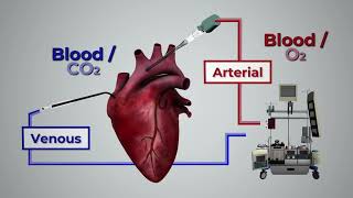 Circulación Extracorpórea ECMO [upl. by Nerraf488]