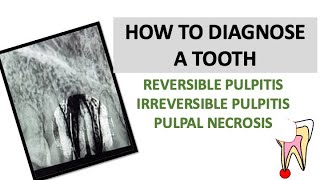 HOW TO DIAGNOSE A TOOTH REVERSIBLE AND IRREVERSIBLE PULPITIS  PULPAL NECROSIS  dentalcafe4331 [upl. by Einafit]