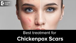 Get rid of skin scars after chickenpox  Dr Rajdeep Mysore  Doctors Circle [upl. by Lakin362]