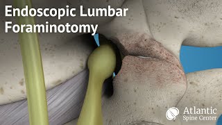 Endoscopic Lumbar Foraminotomy [upl. by Nelyt]