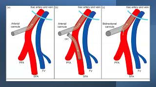 06 Cannulation by Dr Dipanjan Chatterjee ECMO INDIA OCT 2024  Day 01 [upl. by Selmore695]