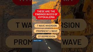 THESE ARE THE FINDINGS IN ECG OF HYPOKALEMIA [upl. by Erinna690]