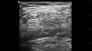 intercostobraquial block [upl. by Mcgean]