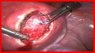 Fibrosis Quística Qué es Diagnostico Sintomas y Tratamiento [upl. by Jordon487]