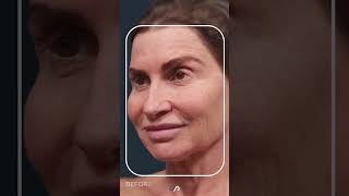 CO2 Laser Resurfacing  Facial Rejuvenation [upl. by Relda]