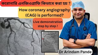 করোনারি এনজিওগ্রাফি কিভাবে করা হয় Live demonstration how Coronary Angiography  CAG is done Dr AP [upl. by Lib]