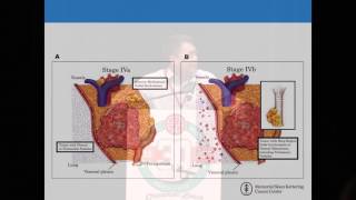 Huang Thymoma Thymic Carcinoma [upl. by Dario325]