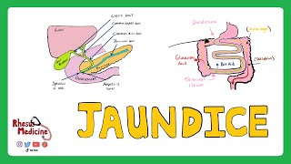 JAUNDICE Differential diagnosis of Jaundice  PrehepaticHepaticPost Hepatic Causes of Jaundice [upl. by Enelrac720]