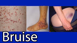 Bruise Hematoma blue spots on skin causes and treatment [upl. by Soirtemed]