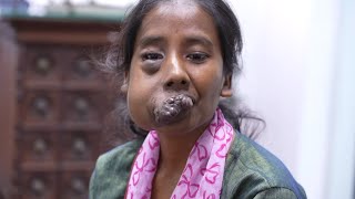 Unbelievable Face Tumor for a Young Girl [upl. by Suoicserp]