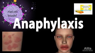 Anaphylaxis Animation [upl. by Sineray]