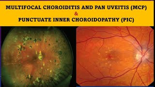 Multifocal choroiditis and Punctate inner choroidopathy [upl. by Ahsiet]