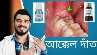 আক্কেল দাঁত নিয়ে সকল সমস্যার সমাধান  How to prevent Wisdom Teeth problem [upl. by Ylerebmik]