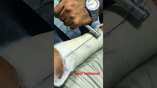 cast removal after one month  4 weeks [upl. by Wehtam608]