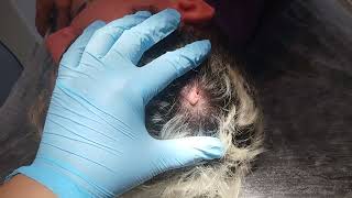 Electrocoagulation of Soft Fibroma on the Scalp [upl. by Kassey602]