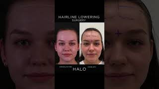 HAIRLINE LOWERING SURGERY  Before amp After [upl. by Stormi851]