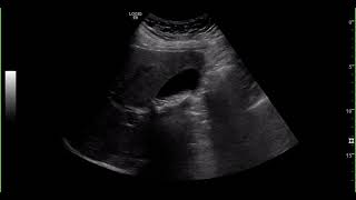 Gallbladder ultrasound [upl. by Syned224]