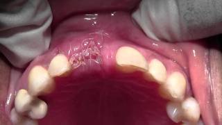 Implant Placement with Bone Grafting 8 Site Mineross amp dPTFE 1 Week postop [upl. by Silma]