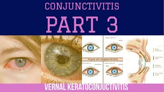 CONJUNCTIVITIS  PART  3  VERNAL KERATOCONJUNCTIVITIS  The White Army [upl. by Aramot]