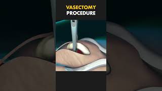 Vasectomy Procedure 3D Animation vasectomy vasectomy medical 3danimation [upl. by Ludie]