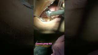 CROWN PREPARATION PREMOLARdentistry dental [upl. by Imorej561]