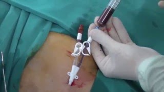 Permanent HD Cath insertion [upl. by Meridel]