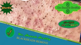 AMAZING NEW UPDATE BETTER REMOVE BLACKHEADS AND REMOVAL BLACKHEADS ON FACE PART 85 [upl. by Aisel]