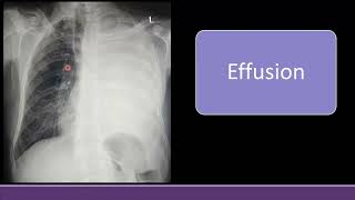 Chest Xray in Pleural Effusion Consolidation Collapse White lung Field radiology cxr [upl. by Drawoh655]