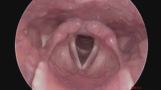 Normal Larynx Endoscopy Without Sound and No Stroboscopy [upl. by Remington]