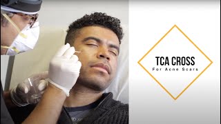 TCA Cross for Acne Scars Darker Skin Tone Ice Pick Scars [upl. by Zehcnas]