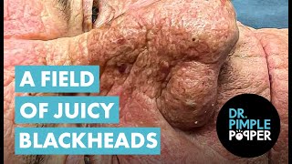 A FIELD OF JUICY BLACKHEADS [upl. by Nalyt890]