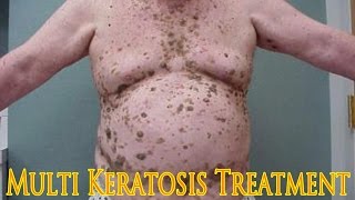 MULTI KERATOSIS Treatment by Liquid Nirtogen Dr Duzhy  Множественные кератомы Лечение [upl. by Bamby]