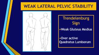 Weak Lateral Pelvic Stability [upl. by Suidaht746]