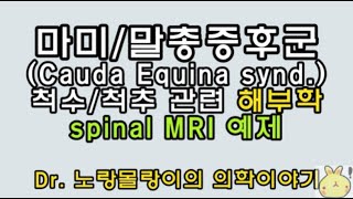 말총마미증후군Cauda equina syndrome 척수척추주변 해부학과 spinal MRI 판독예제 [upl. by Metabel]