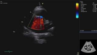 Echocardiography Essentials Mastering the parasternal short axis PSAX view of the aortic valve [upl. by Ahsitruc]