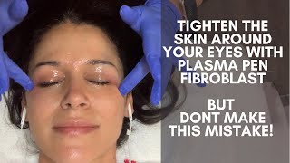 Plasma Pen Fibroblast treatment to tighten skin around my eyes The huge mistake I almost made [upl. by Heidie887]