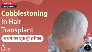 Cobblestoning In Hair Transplant  बचने का एक ही तरीका [upl. by Ecylla]