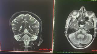 Atrofia cerebral y cerebelar en diferentes pacientes [upl. by Aikemot]