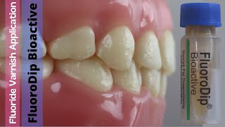 Fluoride Varnish Application ⚪️ FluoroDip Bioactive 🔵 Prevest Denpro [upl. by Koehler]