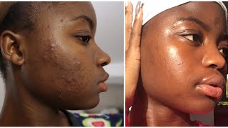 Bilan 2 mois Traitement curacnéroaccutane Accutane Treatment Peau noiredark skin [upl. by Ozne]