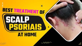 Scalp Psoriasis Removal Home Remedies  Best Treatment Of Scalp Psoriais At Home  Dr Health [upl. by Orimar]