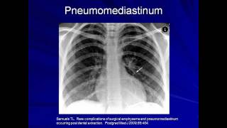 Lung Protective Ventilation Mechanical Ventilation  Lecture 9 [upl. by Yaron]