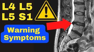 WARNING These Are The 3 MAJOR Symptoms of a Severe L4 L5 L5 S1 Disc Bulge  Dr Walter Salubro [upl. by Ecirtnuahs]