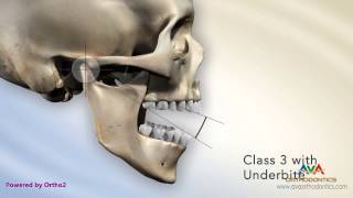 Malocclusion  Underbite or Crossbite Secondary to Short Maxillary Height [upl. by Htabmas]