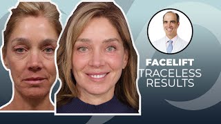 10 YEARS YOUNGER Traceless Facelift Surgery Before and After  Dr David Stoker [upl. by Ecienahs]