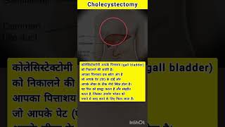 Whats the Cholecystectomy procedure gallbladderstone gallstones gallstonetreatment healthfacts [upl. by Oiredised]