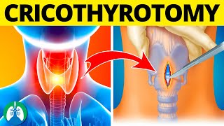 Cricothyrotomy Medical Definition  Quick Explainer Video [upl. by Atiuqet]