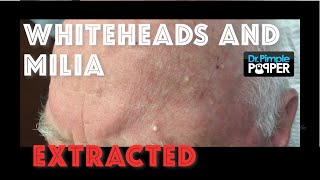 Whiteheads and milia extracted after Mohs surgery [upl. by Doe]